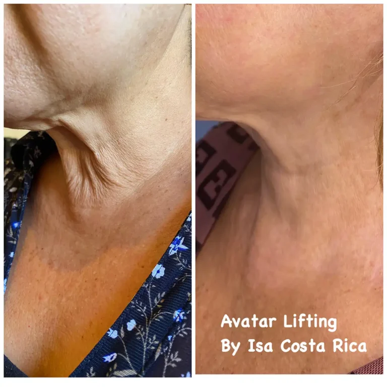 avatar skin lift therapy