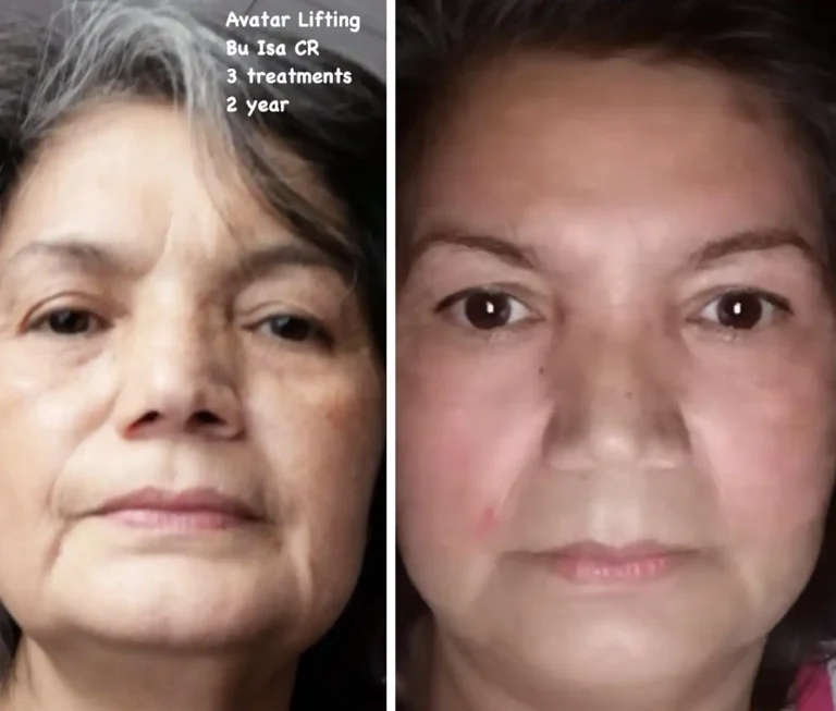 avatar skin lift therapy