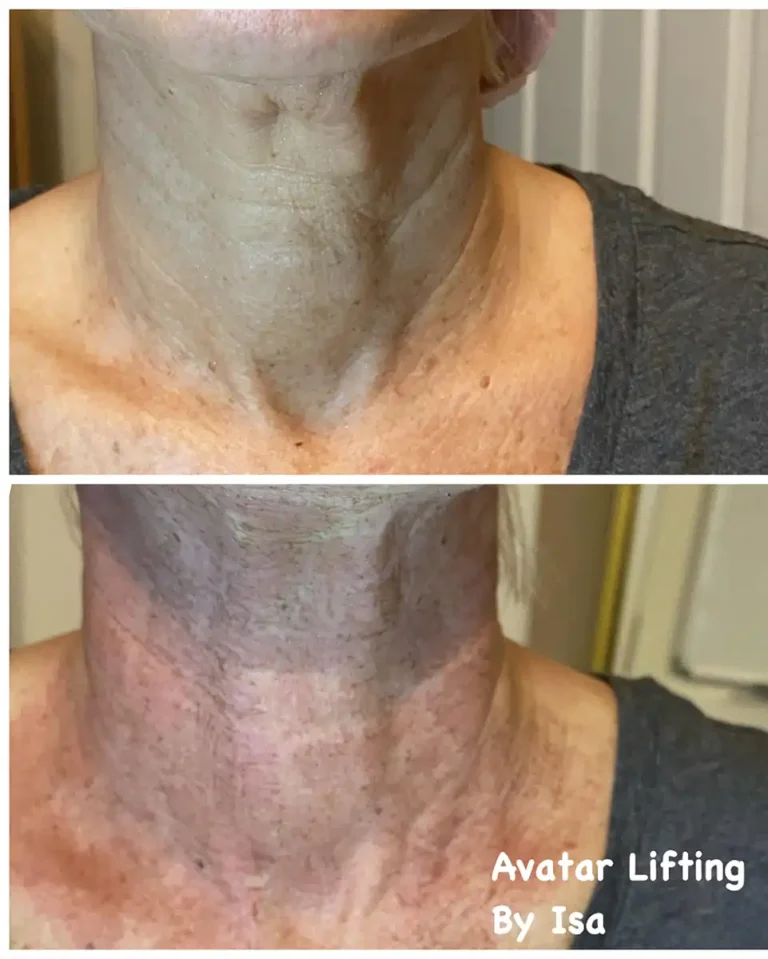avatar skin lift therapy