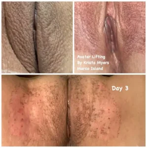 Vaginal Rejuvenation